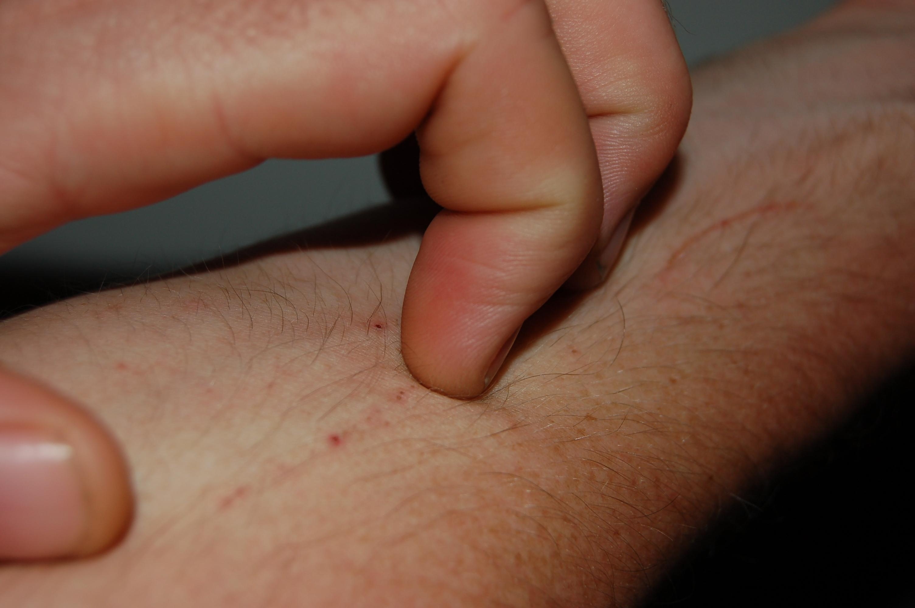 Mosquito Bite Allergies: Skeeter Syndrome - Featured Image